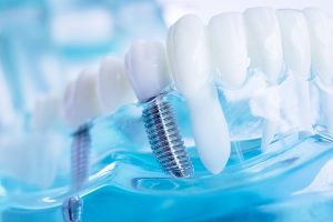 Dental implants and dentures in Port Orange FL