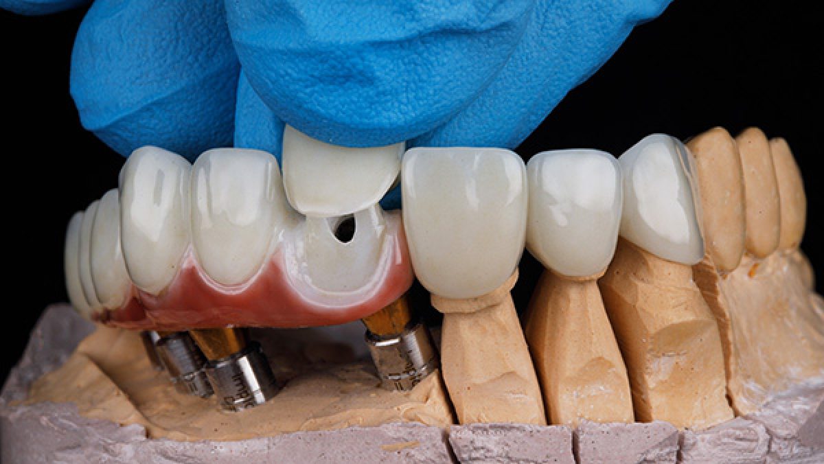 hybrid denture repair in port orange fl